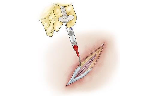Medical illustration of a porous wound matrix conforming to surgical incision margins.