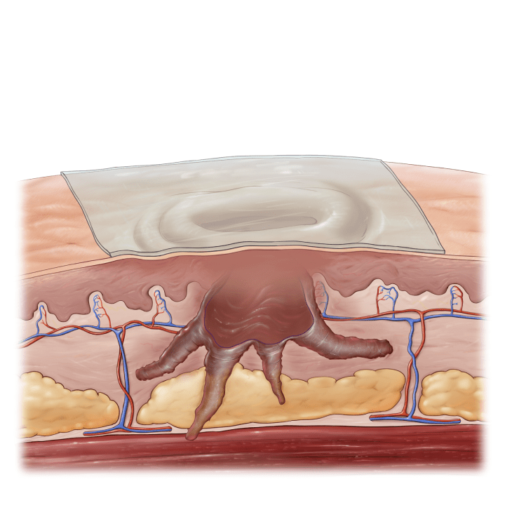 Applying a bandage to a deep wound after G4derm Plus application