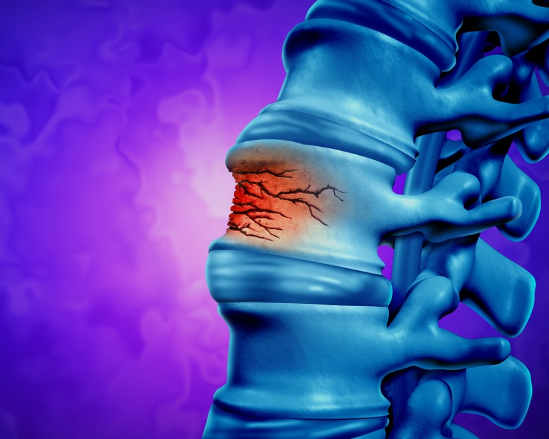 Medical concept of spine fracture used for Gel4Med press release.