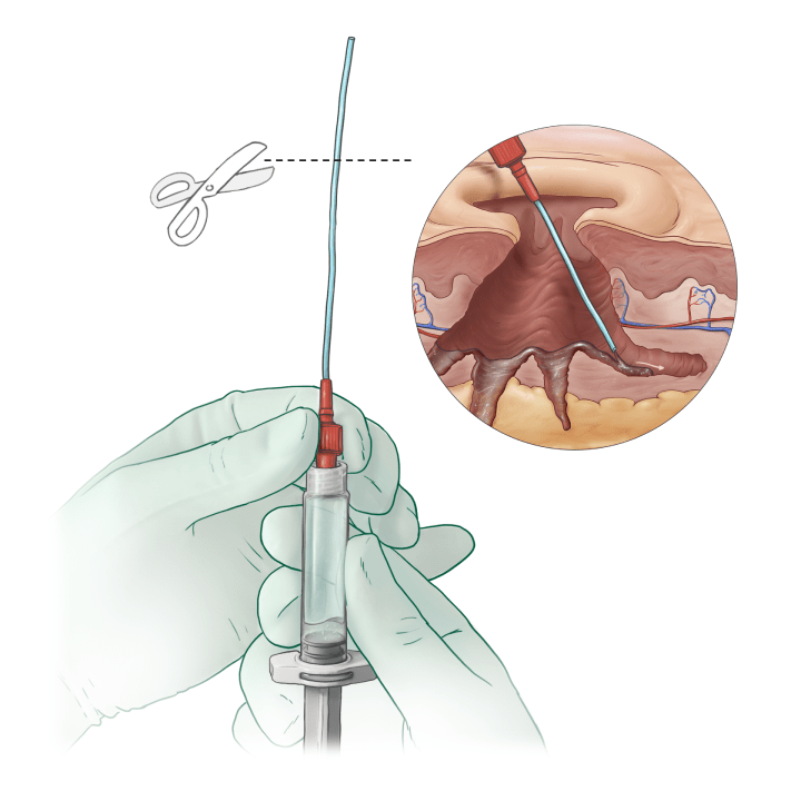 Attaching an applicator tip to the G4derm Plus syringe